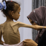 anak palestina kelaparan dan malnutrisi