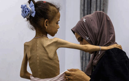 anak palestina kelaparan dan malnutrisi