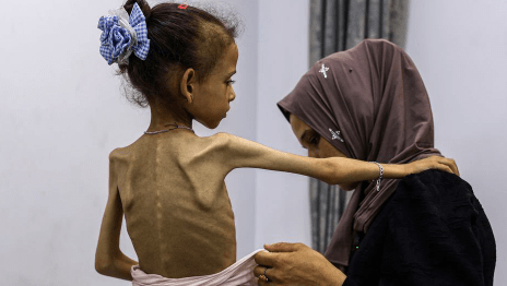 anak palestina kelaparan dan malnutrisi